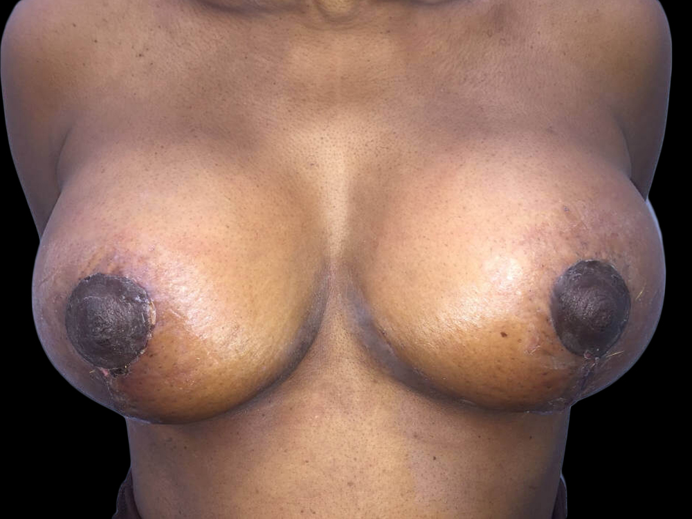 Case--19207 | After Breast Reduction