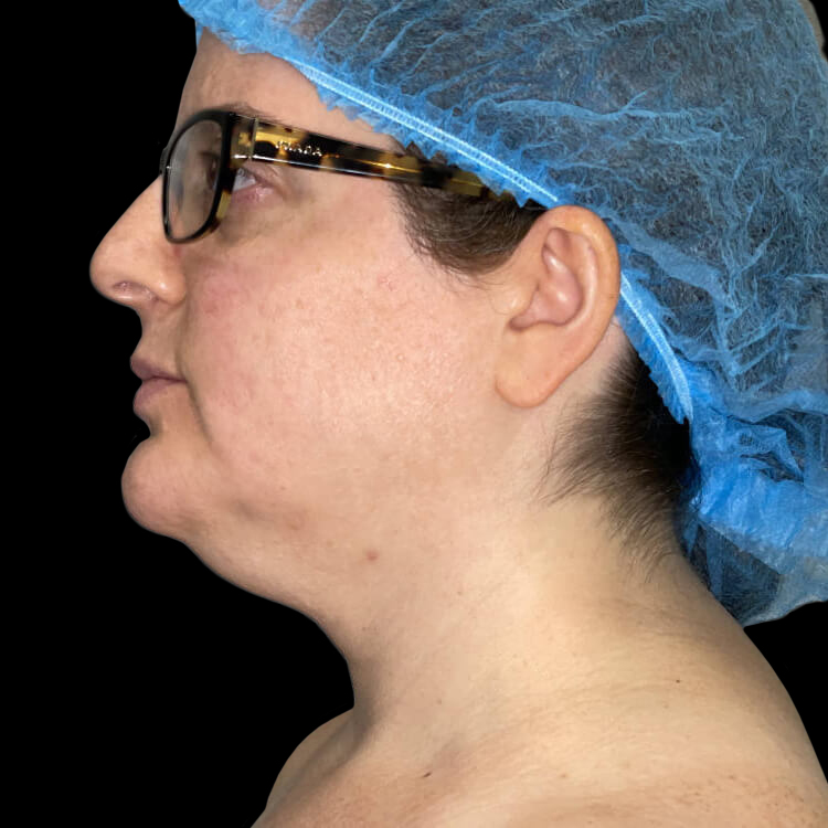 Chin Augmentation Before and After 6a