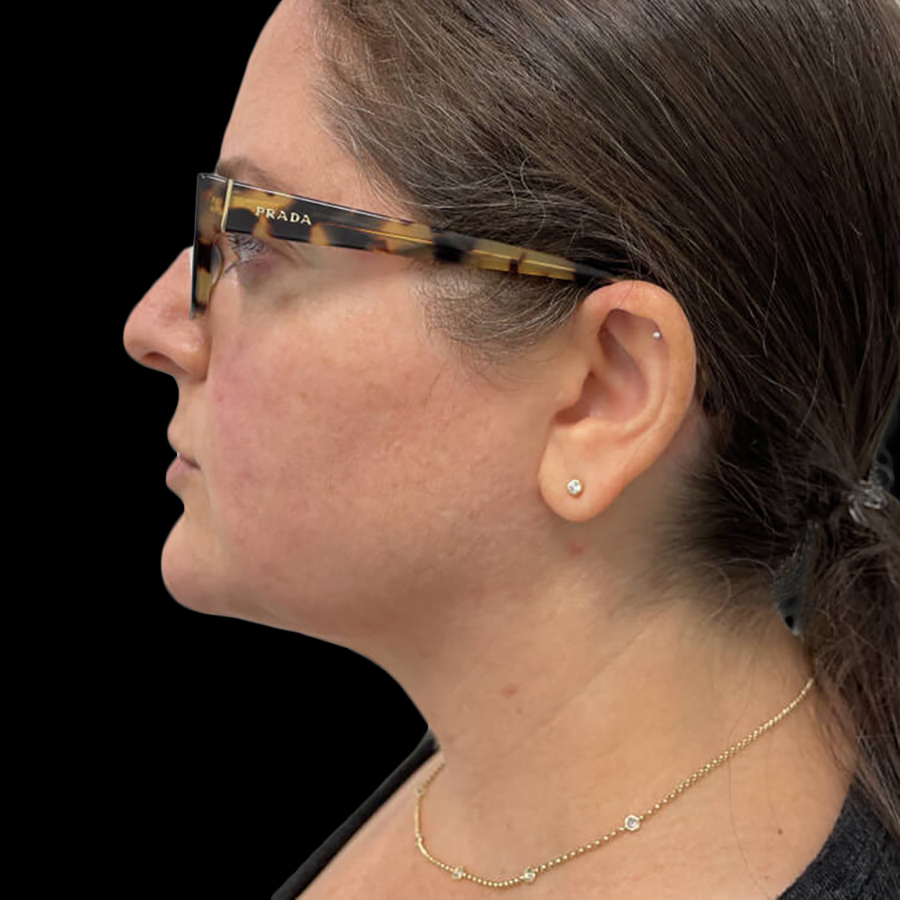 Chin Augmentation Before and After 6b