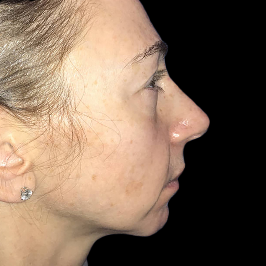 Case--19230 | Before Face