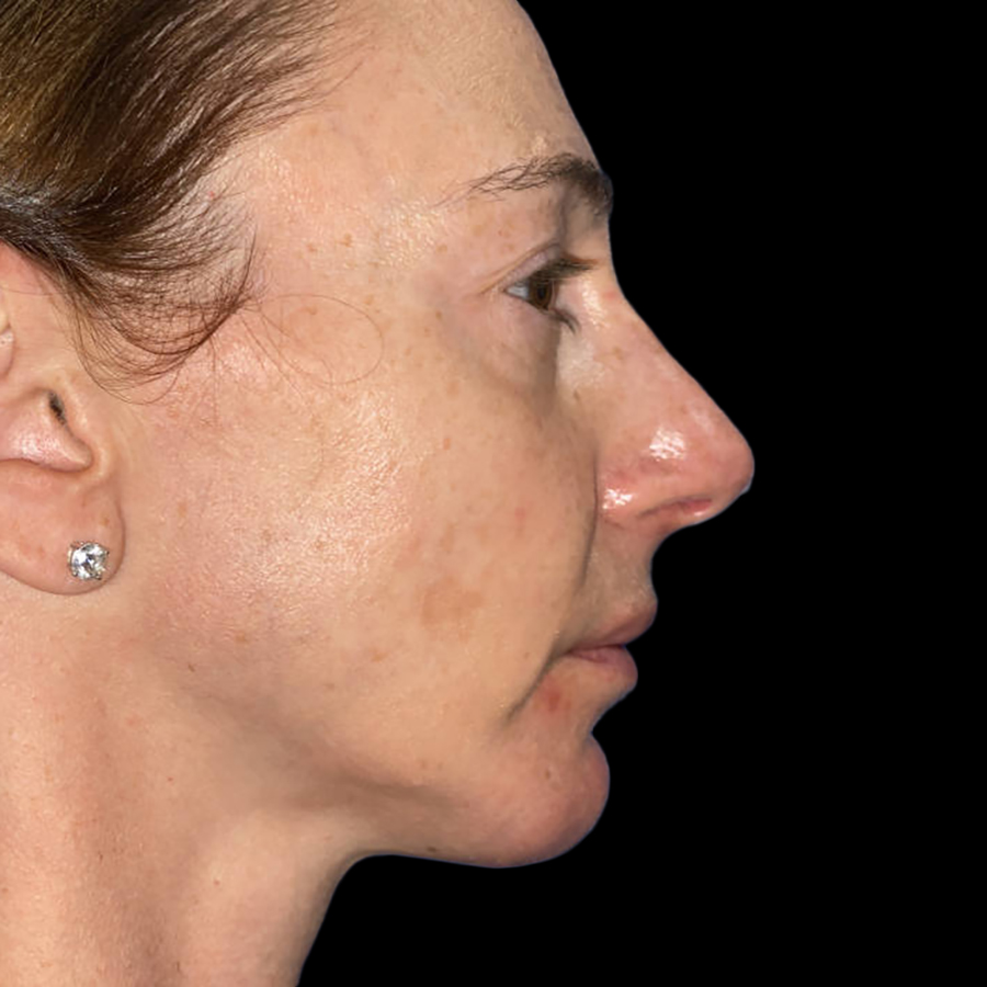 Case--19230 | After Face