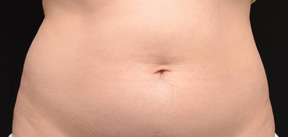 Coolsculpting before and after New York 01