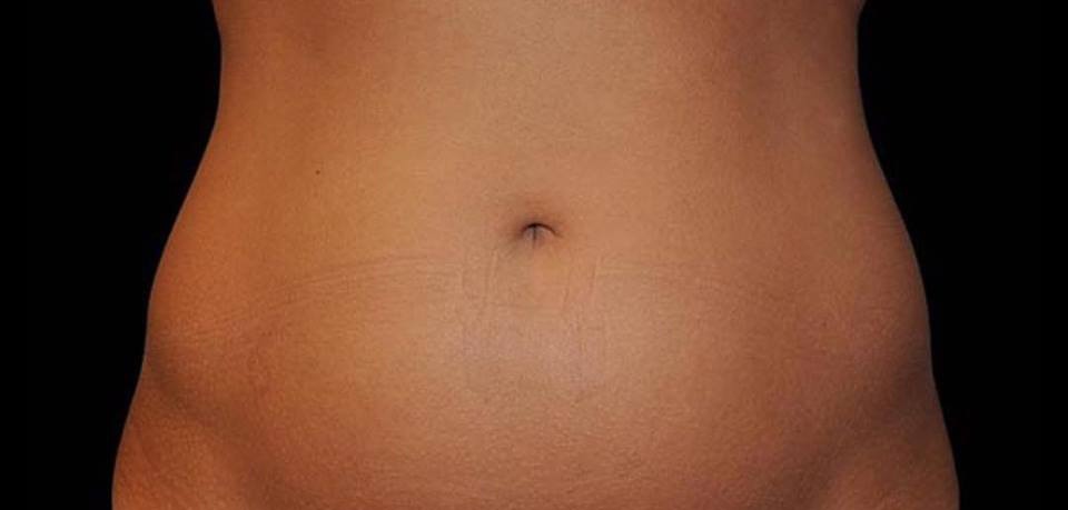 Coolsculpting before and after New York 02