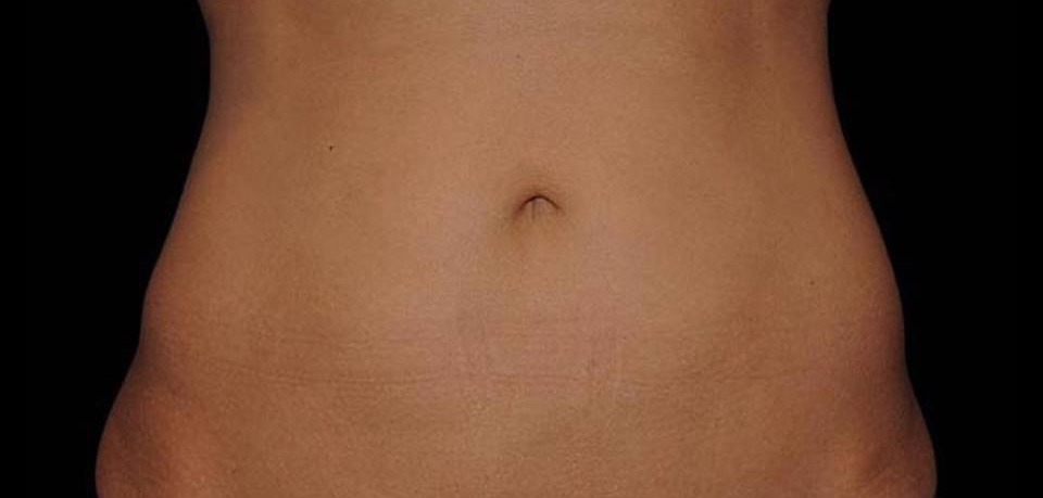 Coolsculpting before and after New York 02b