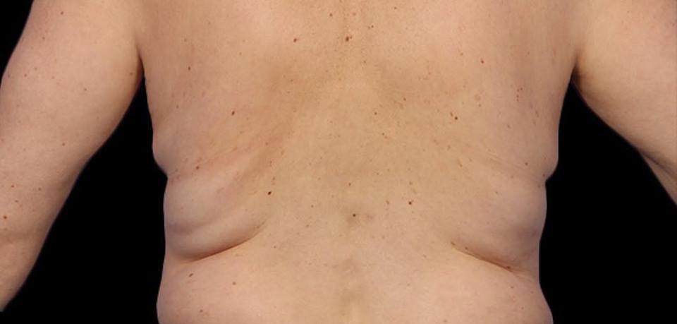 Coolsculpting before and after New York 03