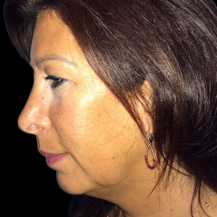 Case--20945 | Before Face