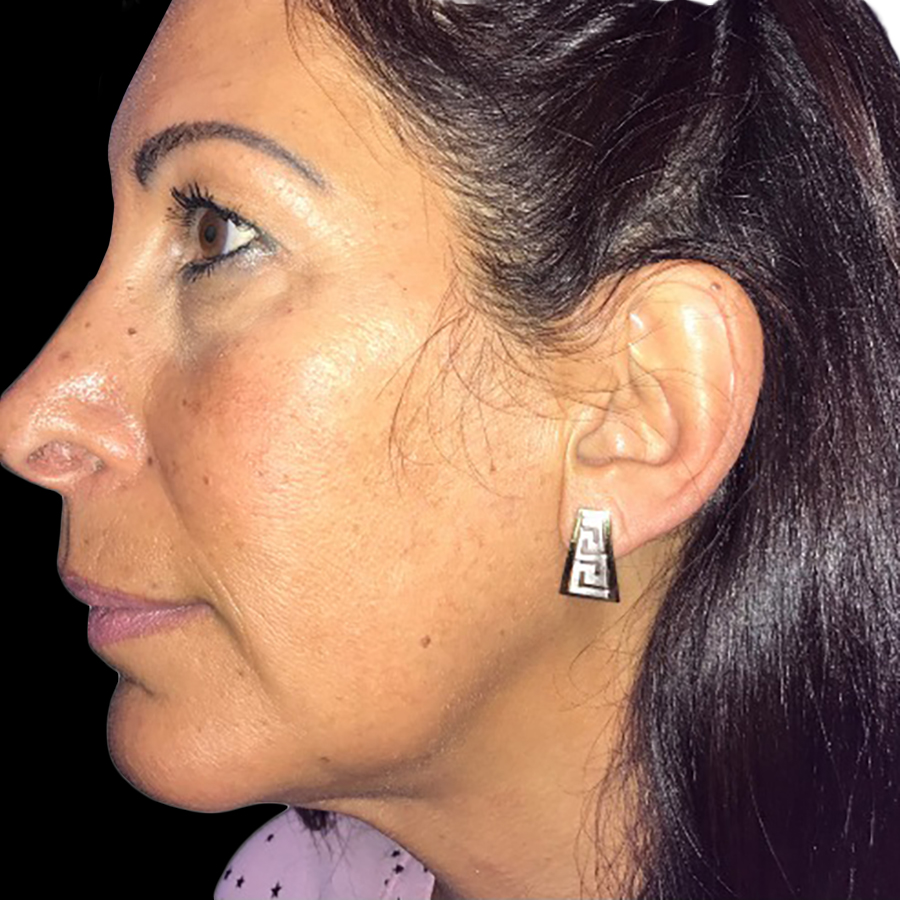 Case--20945 | After Face