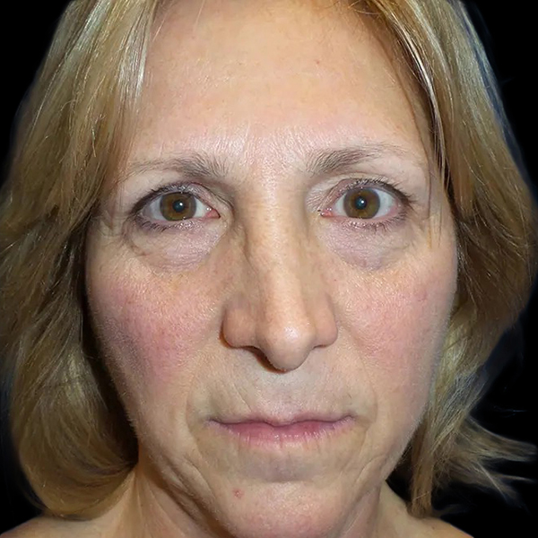 Case--20946 | Before Face