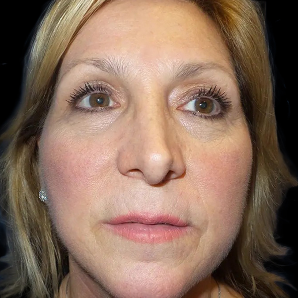 Case--20946 | After Face