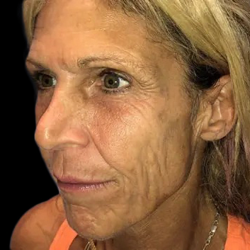 Case--20948 | Before Face