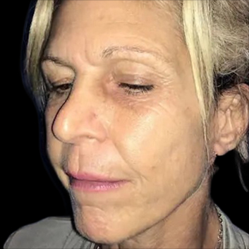 Case--20948 | After Face