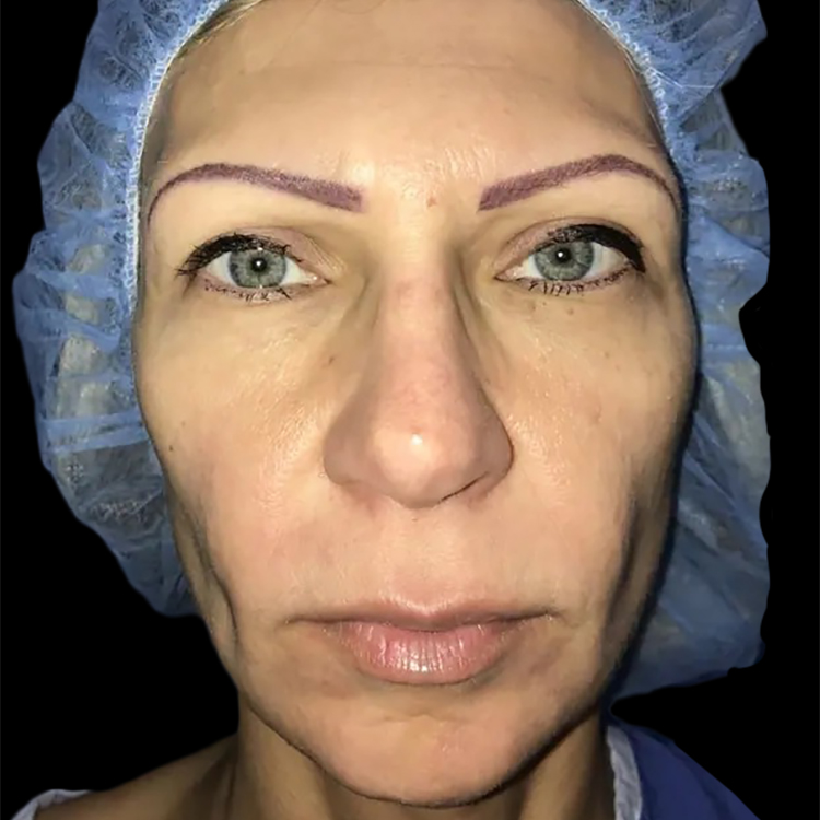 Case--20949 | Before Face