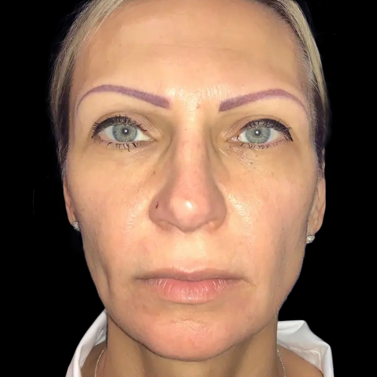 Case--20949 | After Face