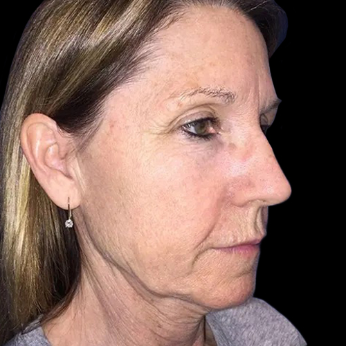 Case--20993 | Before Face