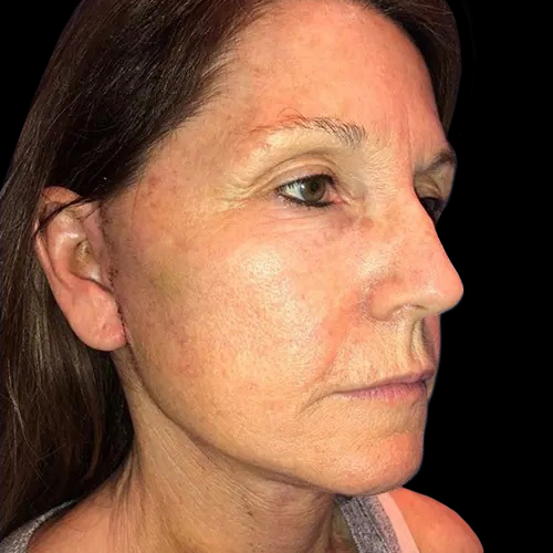 Case--20993 | After Face