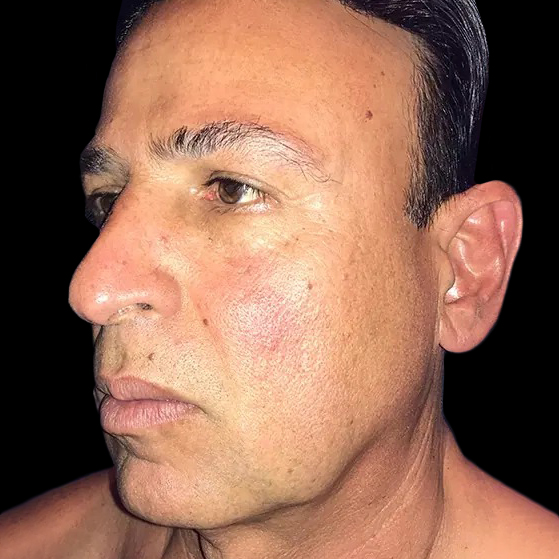 Facelift Before and After 4a