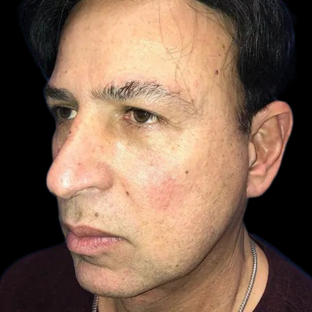 Facelift Before and After 4b