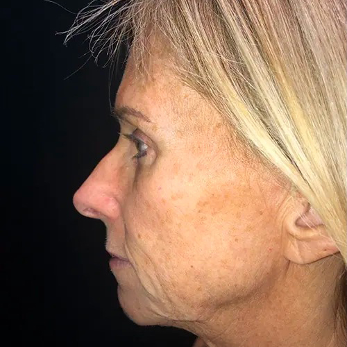 Case--21161 | Before Face