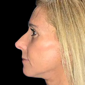 Case--21161 | After Face