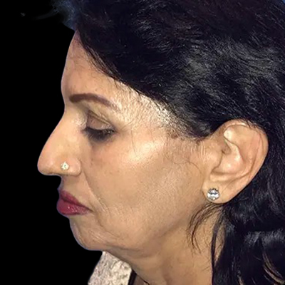 Case--21162 | Before Face