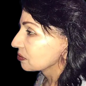 Case--21162 | After Face