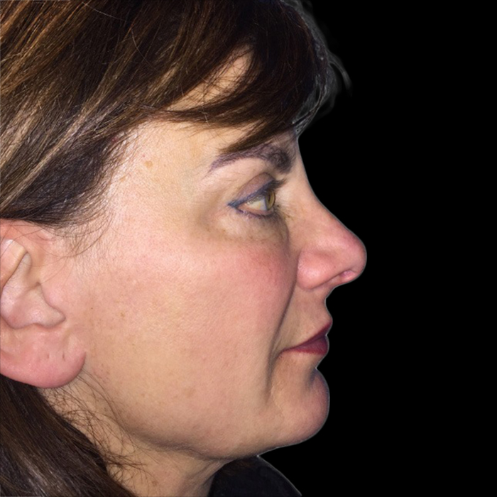 Case--21000 | Before Face