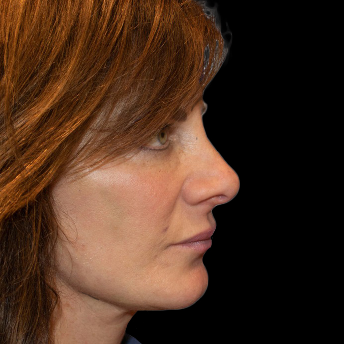 Case--21000 | After Face