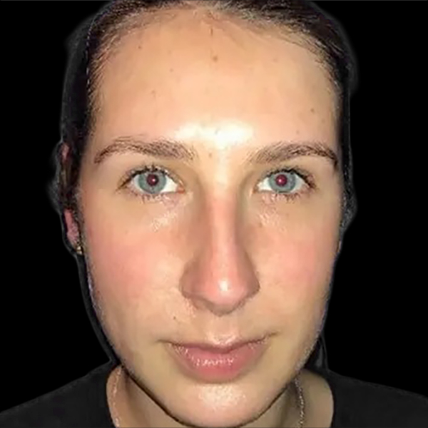 Case--21170 | After Face