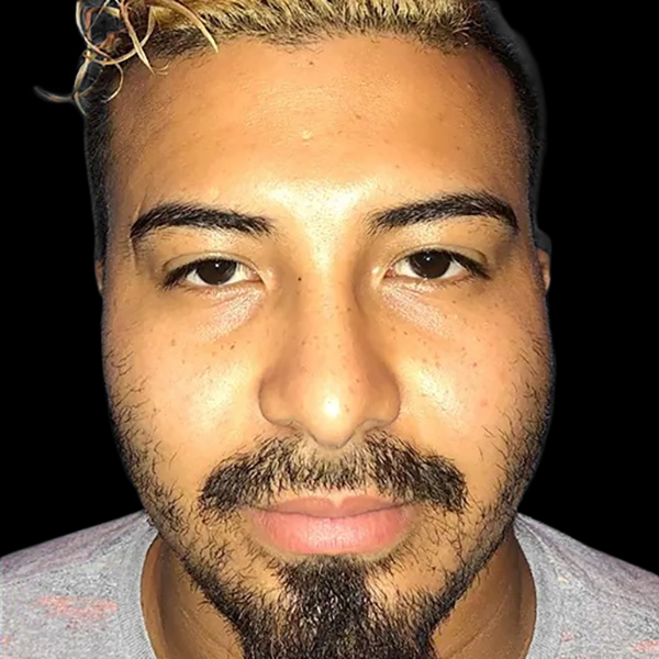 Case--21164 | After Face