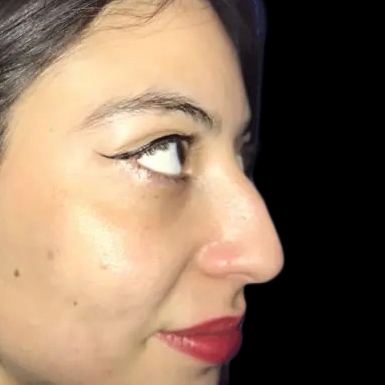 Case--21215 | Before Face