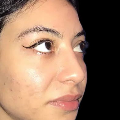 Case--21215 | After Face