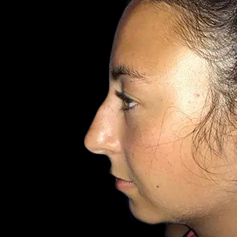 Case--21219 | Before Face