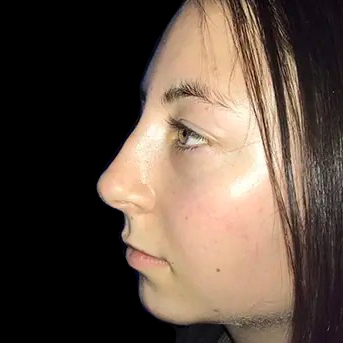 Case--21219 | After Face