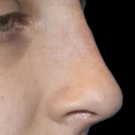 Case--21173 | After Face