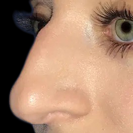 Case--21175 | Before Face