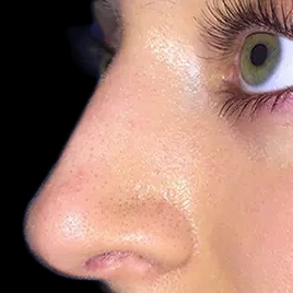 Case--21175 | After Face