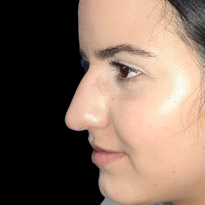 Case--21177 | Before Face