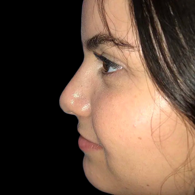 Case--21177 | After Face