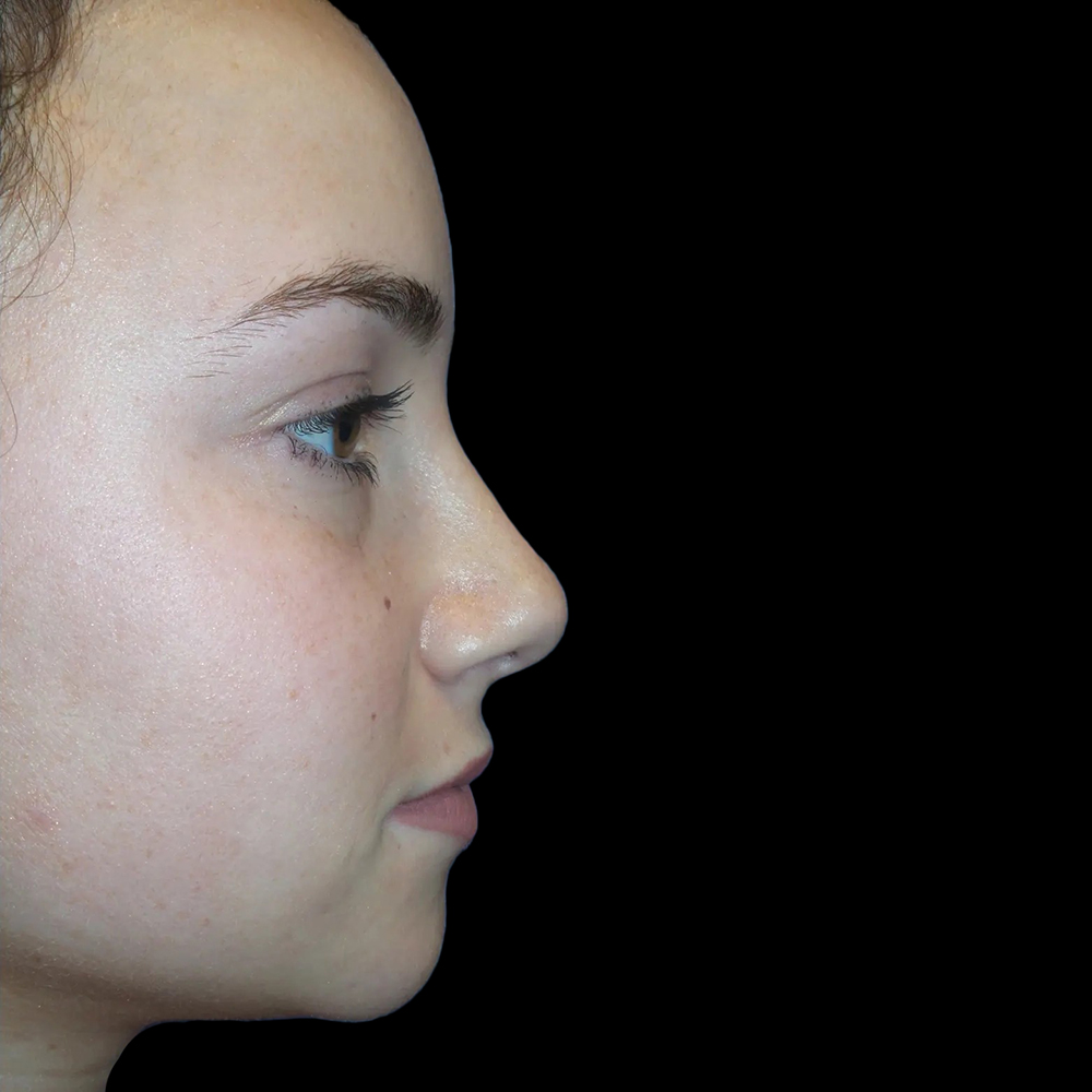 Case--21191 | After Face