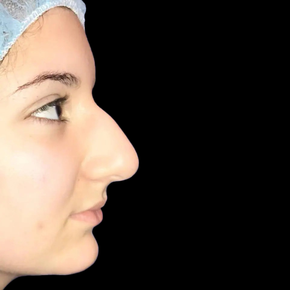 Case--21192 | Before Face