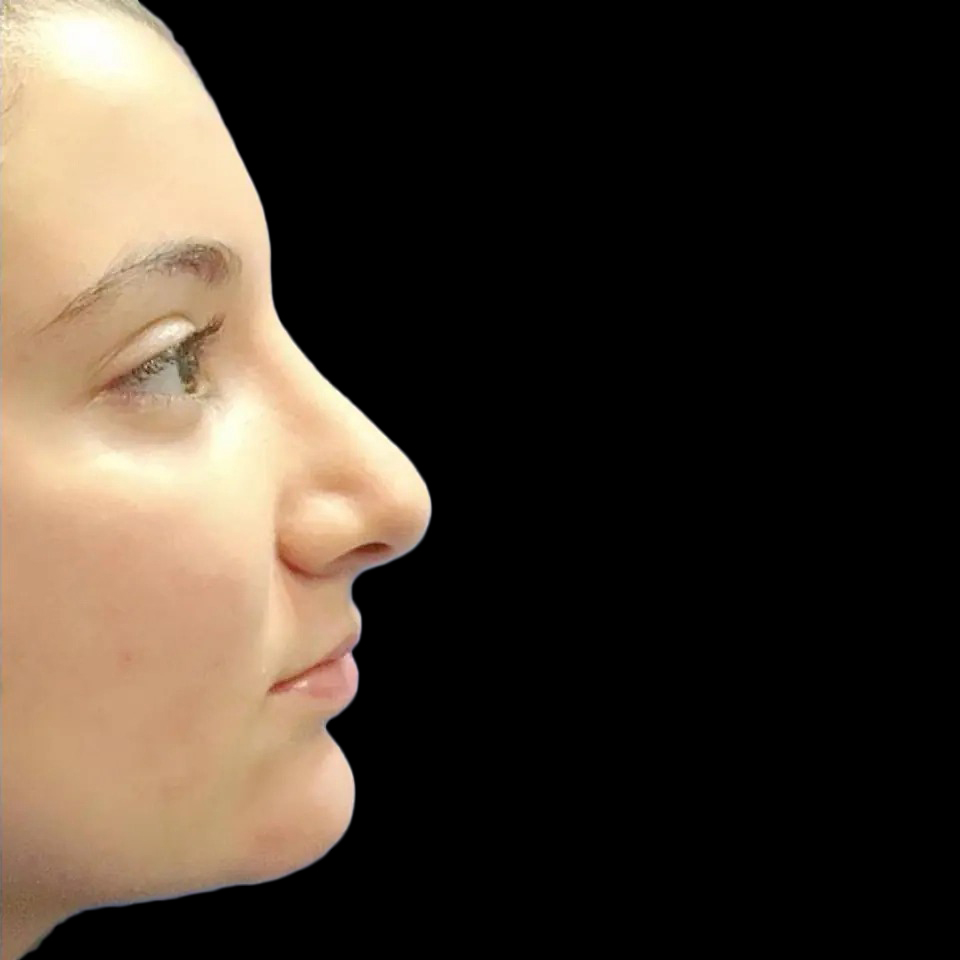 Case--21192 | After Face