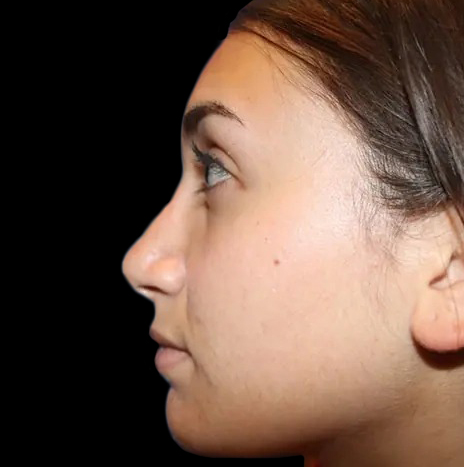 Case--21193 | After Face