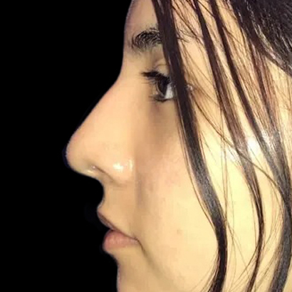 Case--21201 | After Face