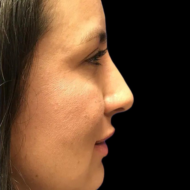 Case--21209 | After Face