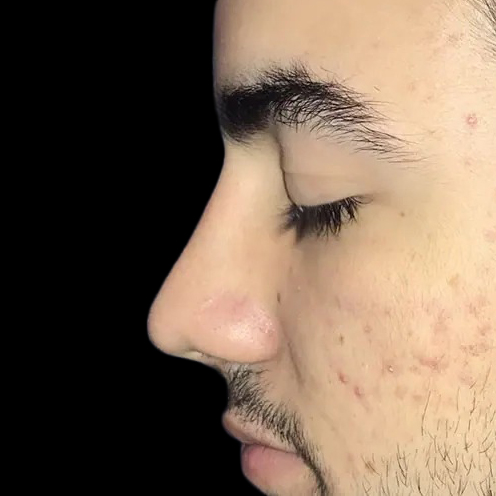 Case--21202 | After Face