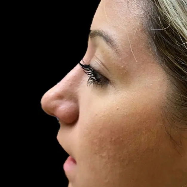 Case--21220 | After Face