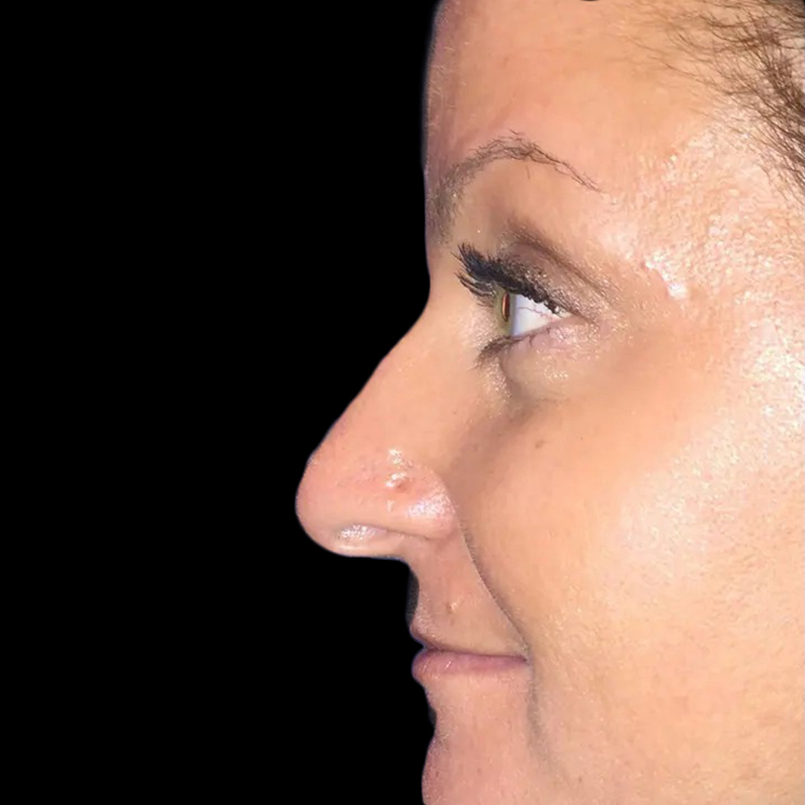 Case--21221 | Before Face