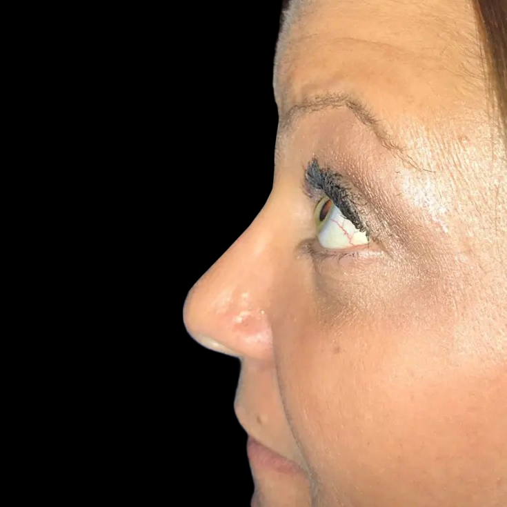 Case--21221 | After Face