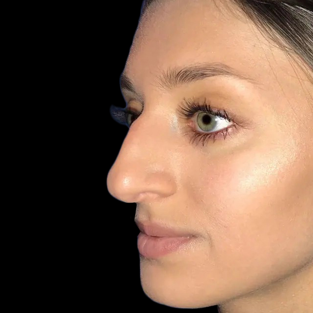 Case--21222 | Before Face