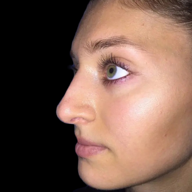 Case--21222 | After Face